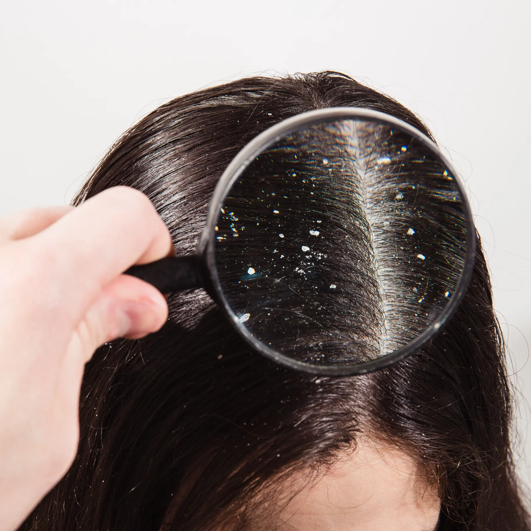 Dandruff Treatment